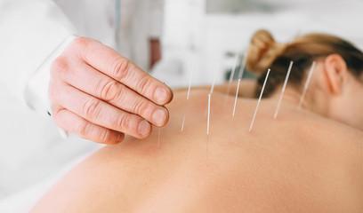 Acupuntura corporal