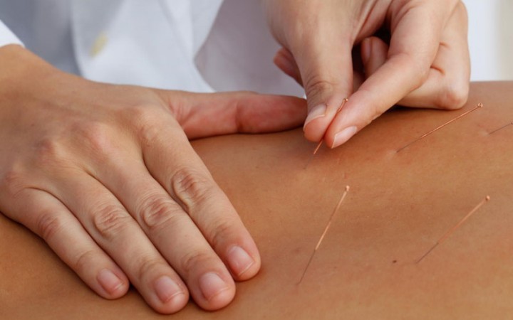 Acupuntura corporal